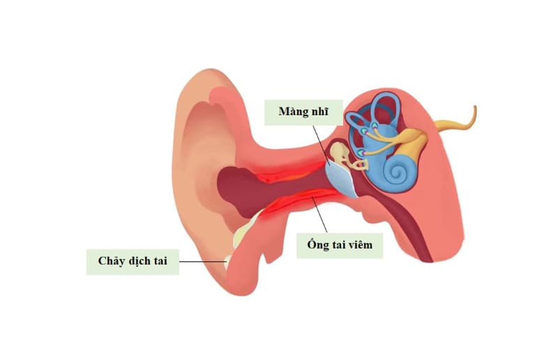 Dấu hiệu Viêm tai ngoài là gì