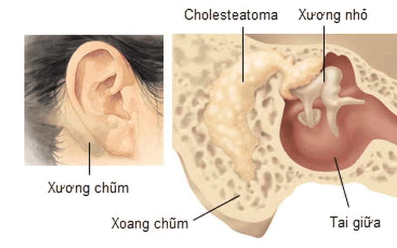 Viêm tai xương chũm nguy hiểm
