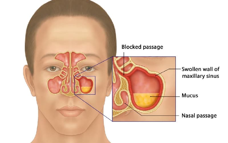 Lý do bị Viêm xoang mạn tính