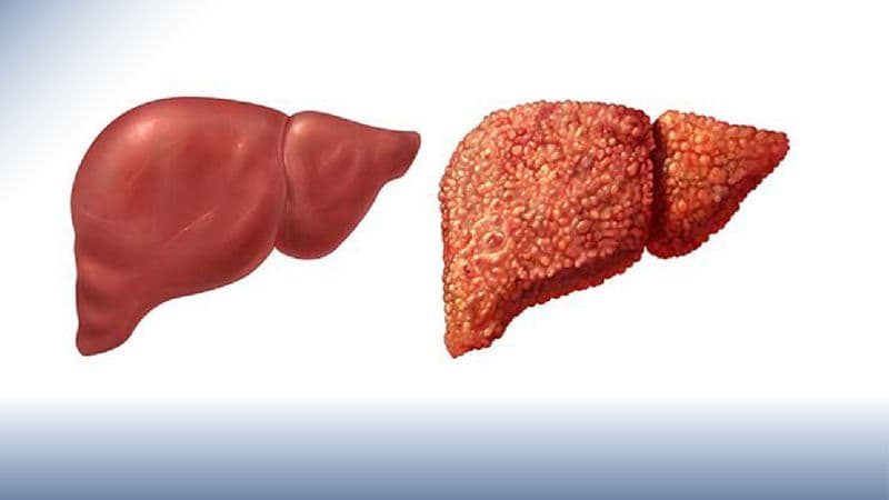 Xơ gan là bệnh gì?