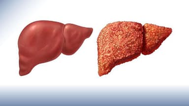 Xơ gan: Những hệ lụy nghiêm trọng và hướng điều trị hiệu quả