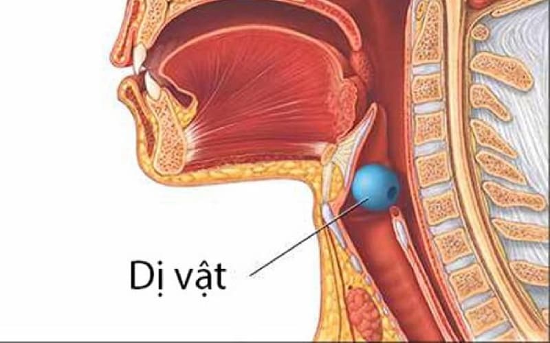 Nhận biết và Xử trí hóc dị vật đường thở