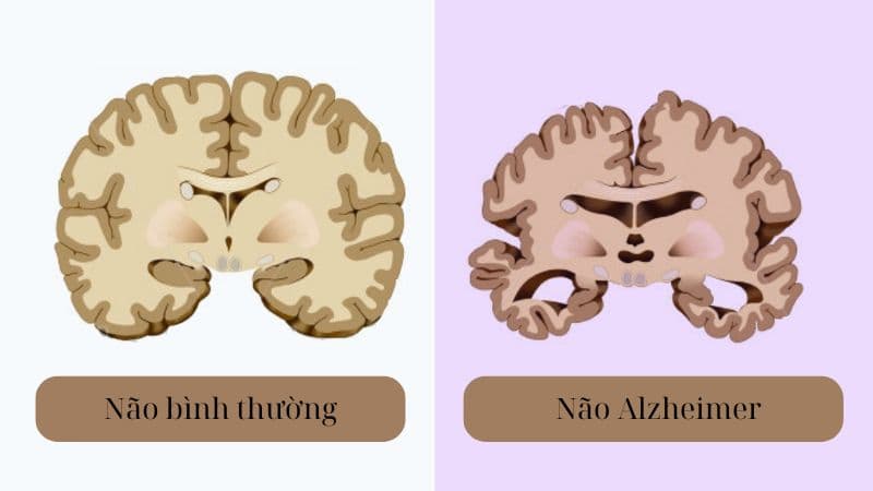 Alzheimer nguyên nhân do sự bất thường của não