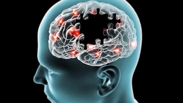 Bệnh Alzheimer nguyên nhân do đâu và dấu hiệu nhận diện sớm