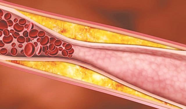 Những sai lầm phổ biến trong chế độ ăn của người bị mỡ máu