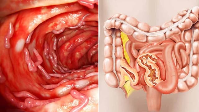 Bệnh Crohn là gì: Nguyên nhân, triệu chứng và điều trị