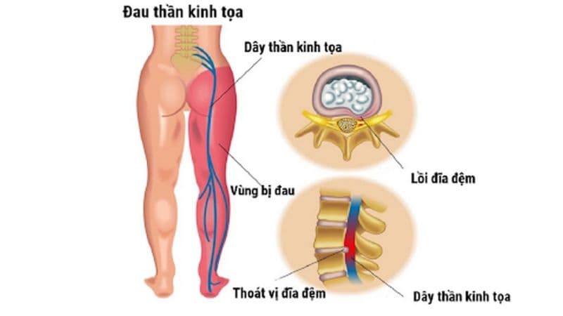 Đau dây thần kinh tọa là bệnh gì?