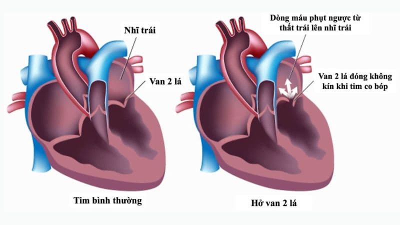 Các loại hở van tim