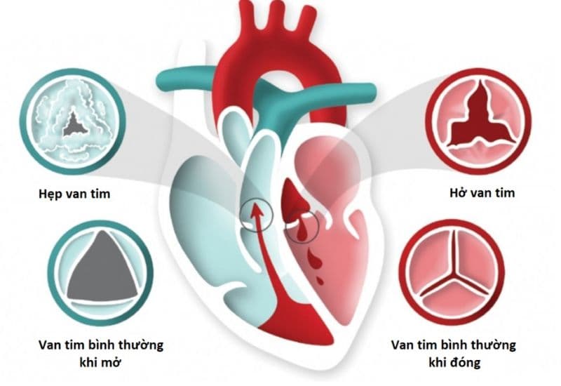 Bệnh hở van tim là gì?