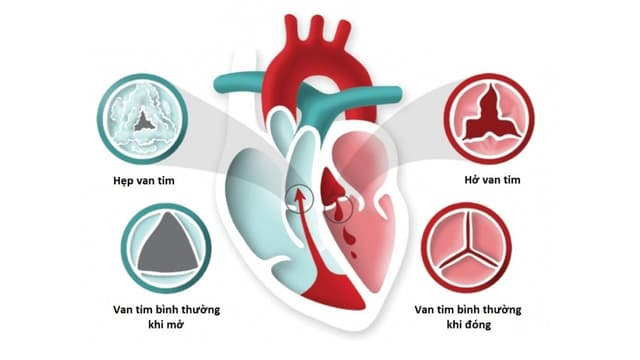Bệnh hở van tim: Các dạng chính, đặc điểm và cách điều trị