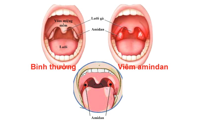 Bị viêm amidan do đâu