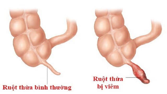 3 Triệu chứng thường gặp của bệnh lý viêm ruột thừa