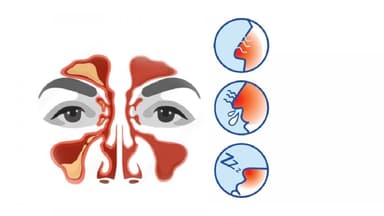 Những dấu hiệu cảnh báo bị viêm xoang và cách điều trị