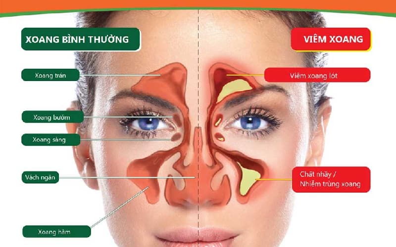 triệu chứng bị viêm xoang