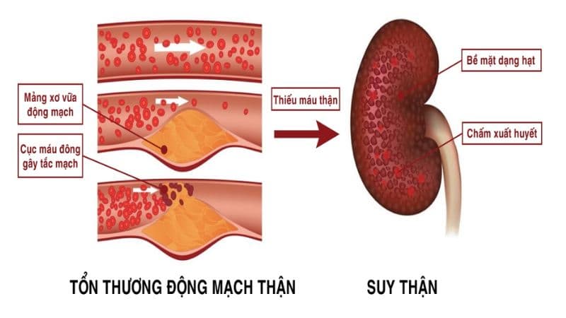 Tăng huyết áp biến chứng suy thận