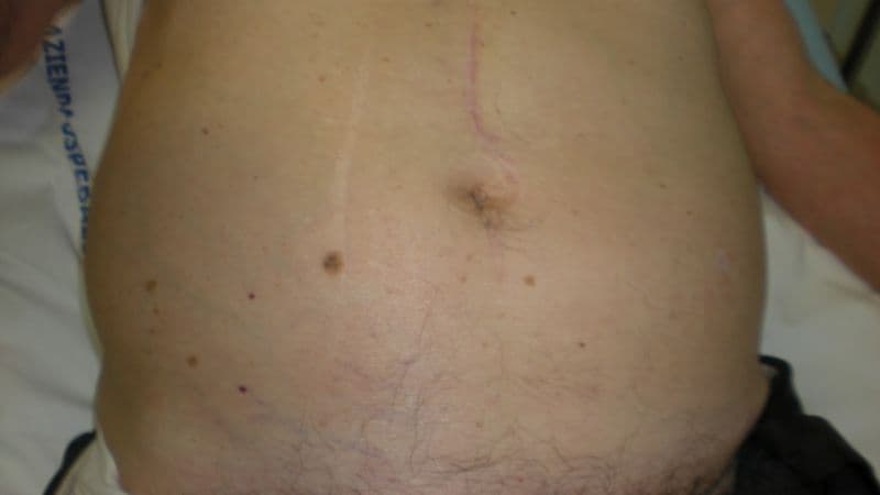 Dấu hiệu xơ gan do bia rượu