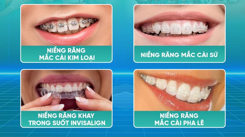 Tìm hiểu về các cách niềng răng