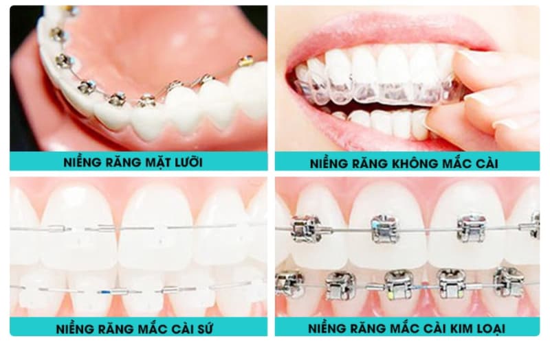 cách niềng răng nào rẻ