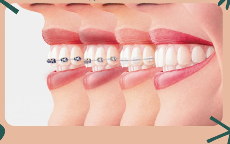 hỏi về cách niềng răng