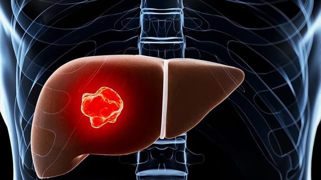 Cách xử lý hiệu quả khi u gan vỡ