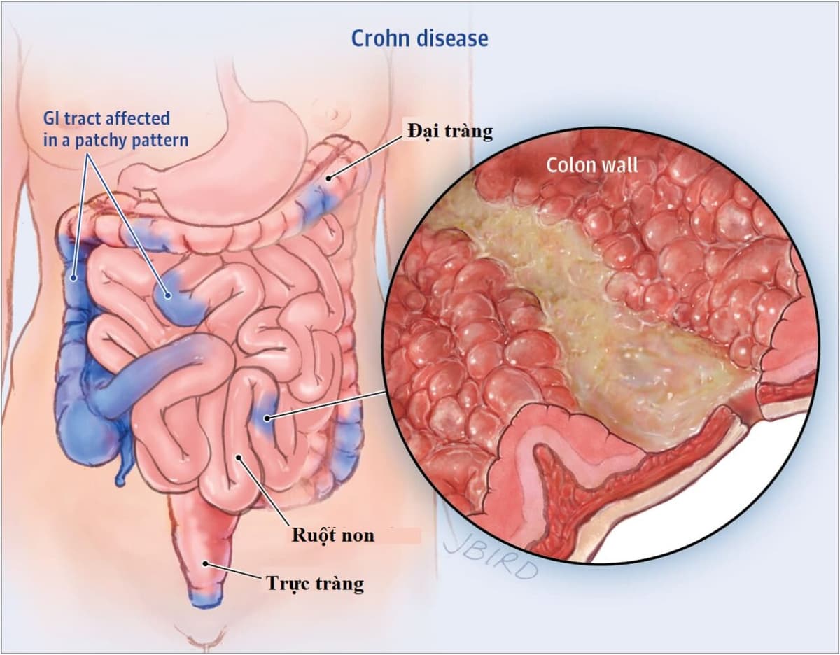 Cách chẩn đoán bệnh Crohn và phương pháp điều trị