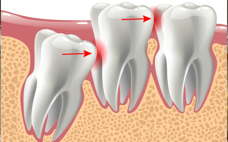 Chữa đau răng khi mọc răng khôn đơn giản