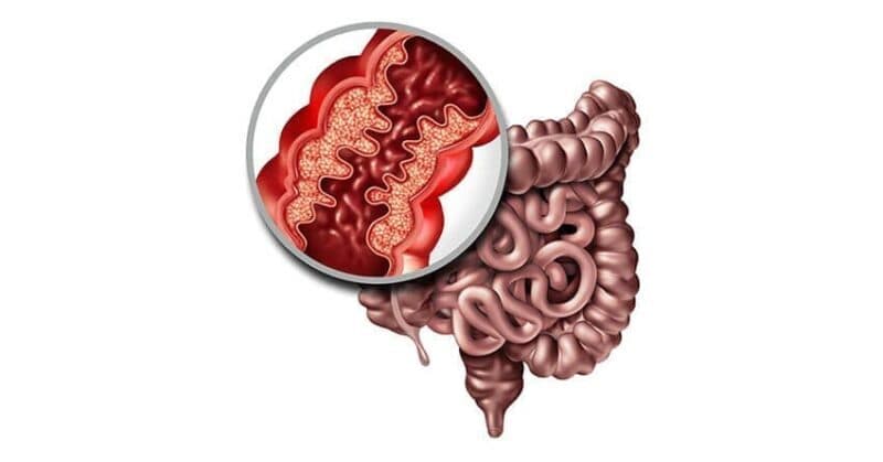 Bệnh Crohn cần được điều trị kịp thời để hạn chế các biến chứng nguy hiểm.
