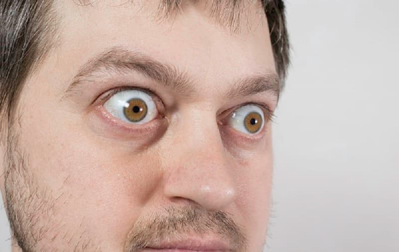 Cổ to, lồi mắt (nếu do Basedow)