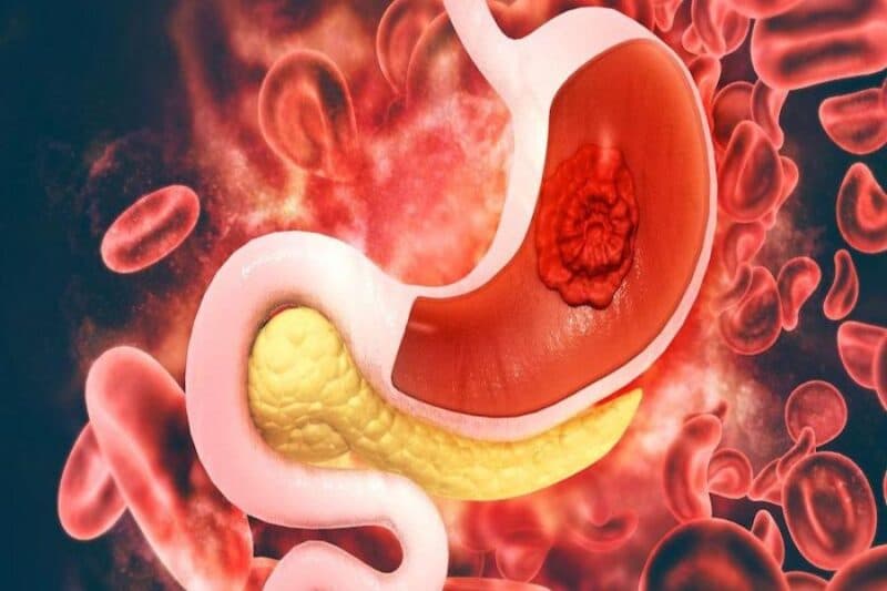 Đau dạ dày sôi bụng thường do bệnh lý viêm loét dạ dày hoặc rối loạn tiêu hóa.