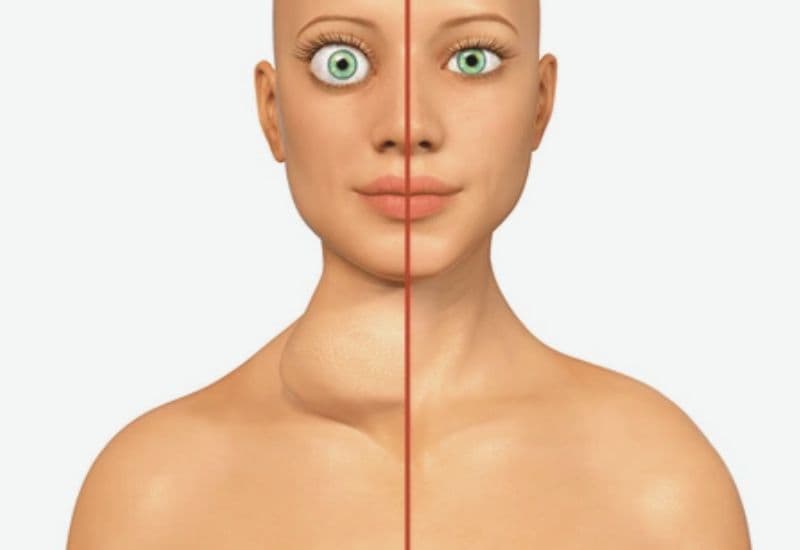 Dấu hiệu nhận biết bướu giáp Basedow