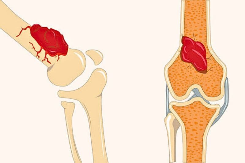 xét nghiệm ung thư xương để xác định khối u