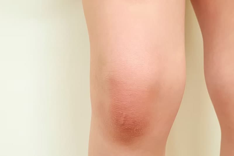 ung thư xương thường hay sưng xương