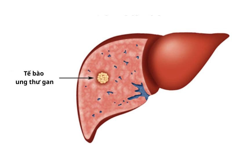 gan bị ung thư giai đoạn đầu có triệu chứng nào