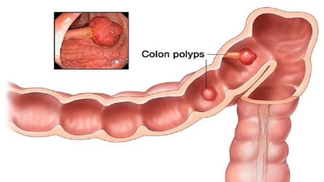 Dấu hiệu polyp đại tràng: Nhận biết sớm để ngăn ngừa biến chứng nguy hiểm