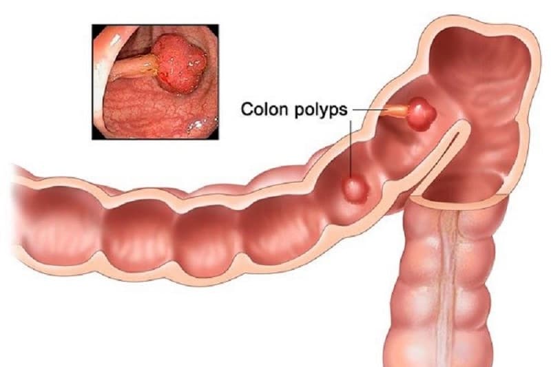 Polyp đại tràng là những khối mô tăng sinh bất thường từ lớp niêm mạc đại tràng