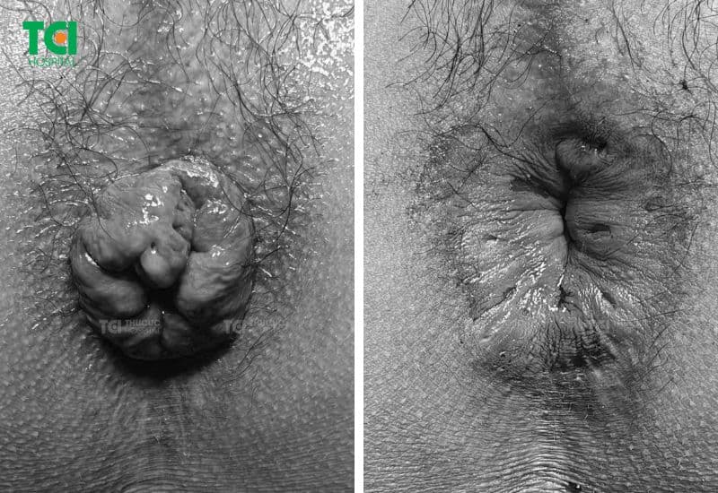 Hậu môn sau khi đốt trĩ