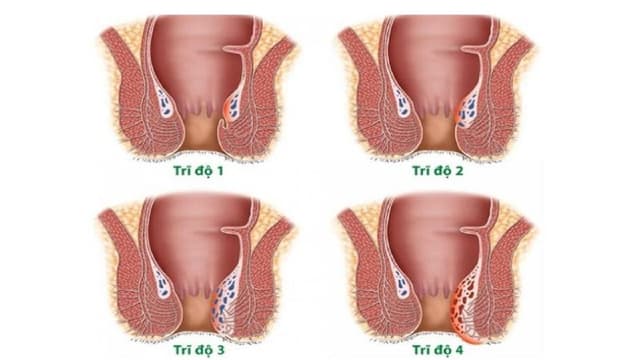 Dấu hiệu trĩ nội độ 2: Nhận biết sớm và cách xử lý hiệu quả