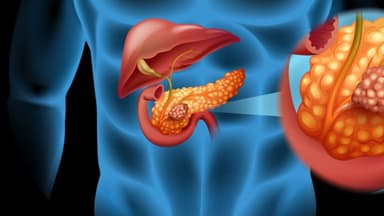 Dấu hiệu ung thư tụy ở người tiểu đường