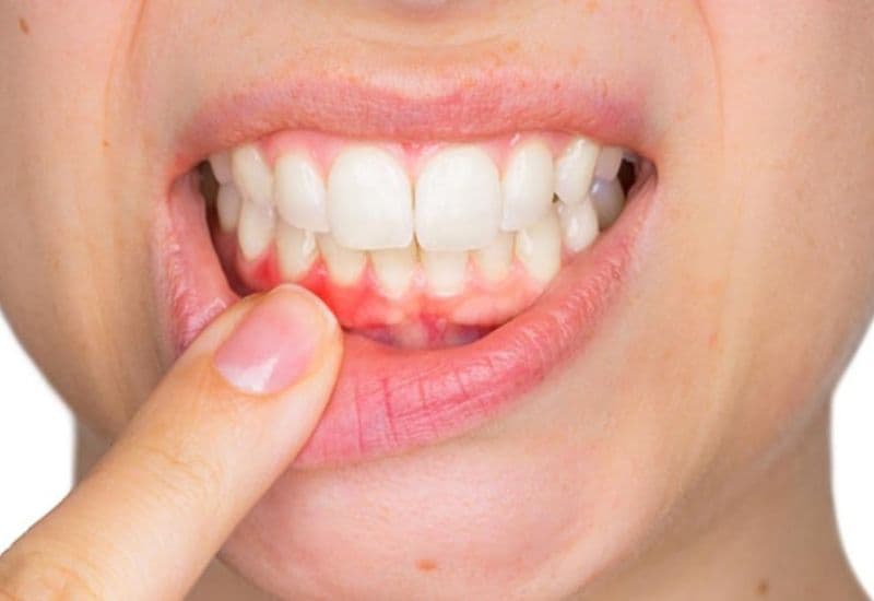 Đau răng lợi ảnh hưởng không nhỏ đến việc ăn uống và hoạt động thường ngày.