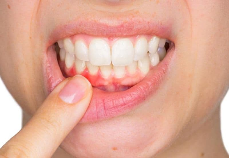 Đau viêm lợi là dấu hiệu cảnh báo các vấn đề răng miệng nghiêm trọng như viêm nha chu hay mất răng.