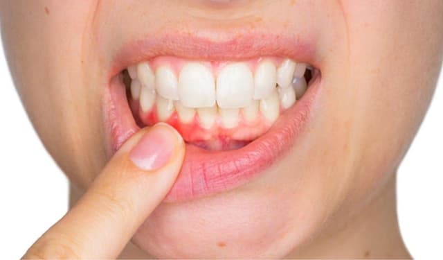 Đau viêm lợi: Nguyên nhân, dấu hiệu và cách cải thiện hiệu quả