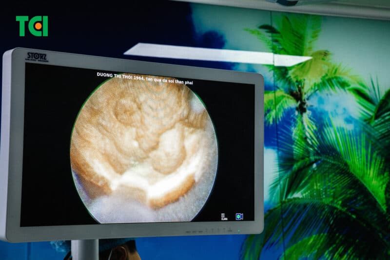 Những ai nên thực hiện phương pháp tán sỏi qua da?