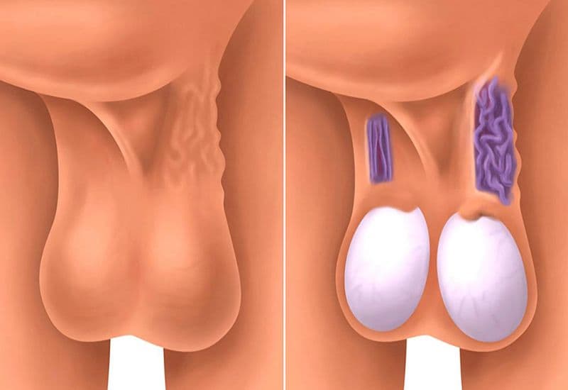 Giãn tĩnh mạch thừng tinh là gì?