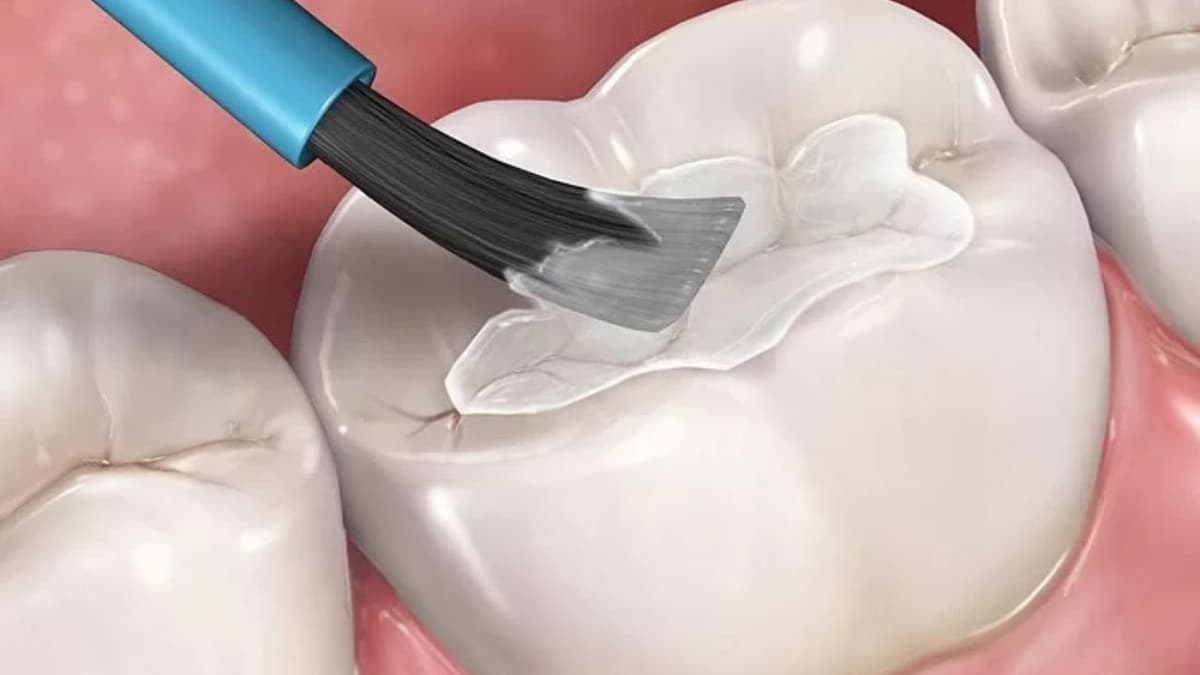 7 Lợi ích vượt trội của phương pháp hàn trám răng hiện đại