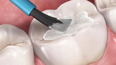 7 Lợi ích vượt trội của phương pháp hàn trám răng hiện đại