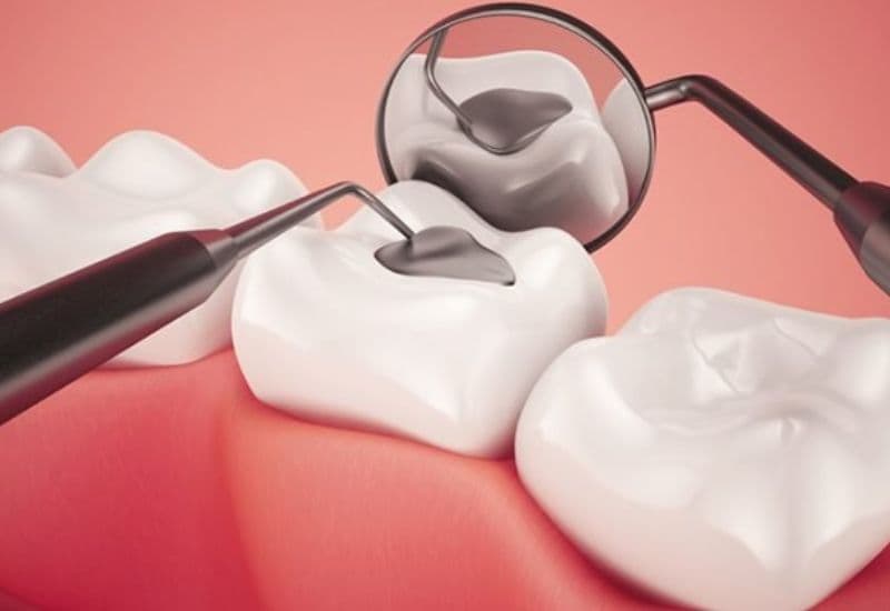 Với tính thẩm mỹ cao và chi phí hợp lý, hàn trám răng đang trở thành lựa chọn phổ biến của nhiều người.