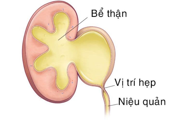 Thận ứ nước do hẹp khúc nối là gì?