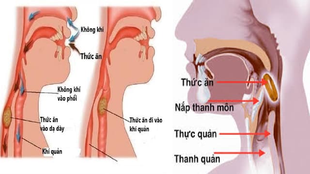 Hóc dị vật đường thở – Những sai lầm điển hình khi sơ cứu
