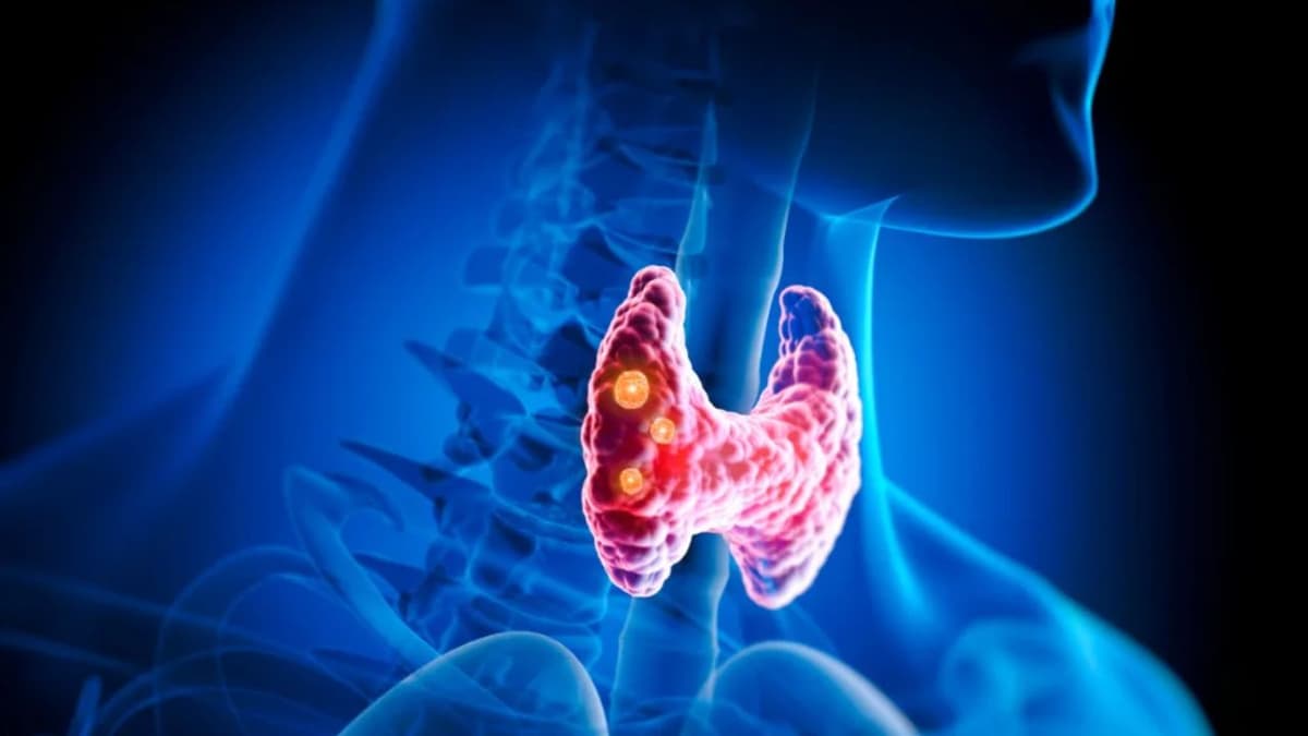 Cách phát hiện sớm khối u tuyến giáp ác tính