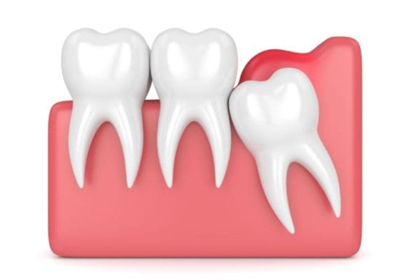 Giai đoạn mọc răng khôn thường tiềm ẩn nguy cơ viêm lợi trùm gây đau nhức.